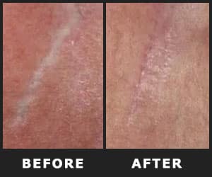Removes Stretch Marks - INS2003 Removes Stretch Marks - INS2003